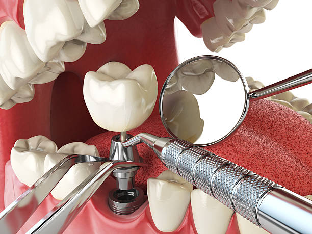Best Emergency Broken Tooth Repair in Hays, MT
